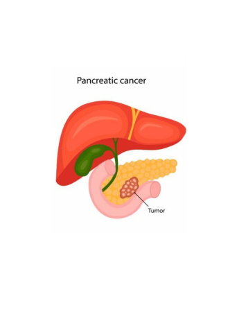 Pancreatic Cancer Treatment